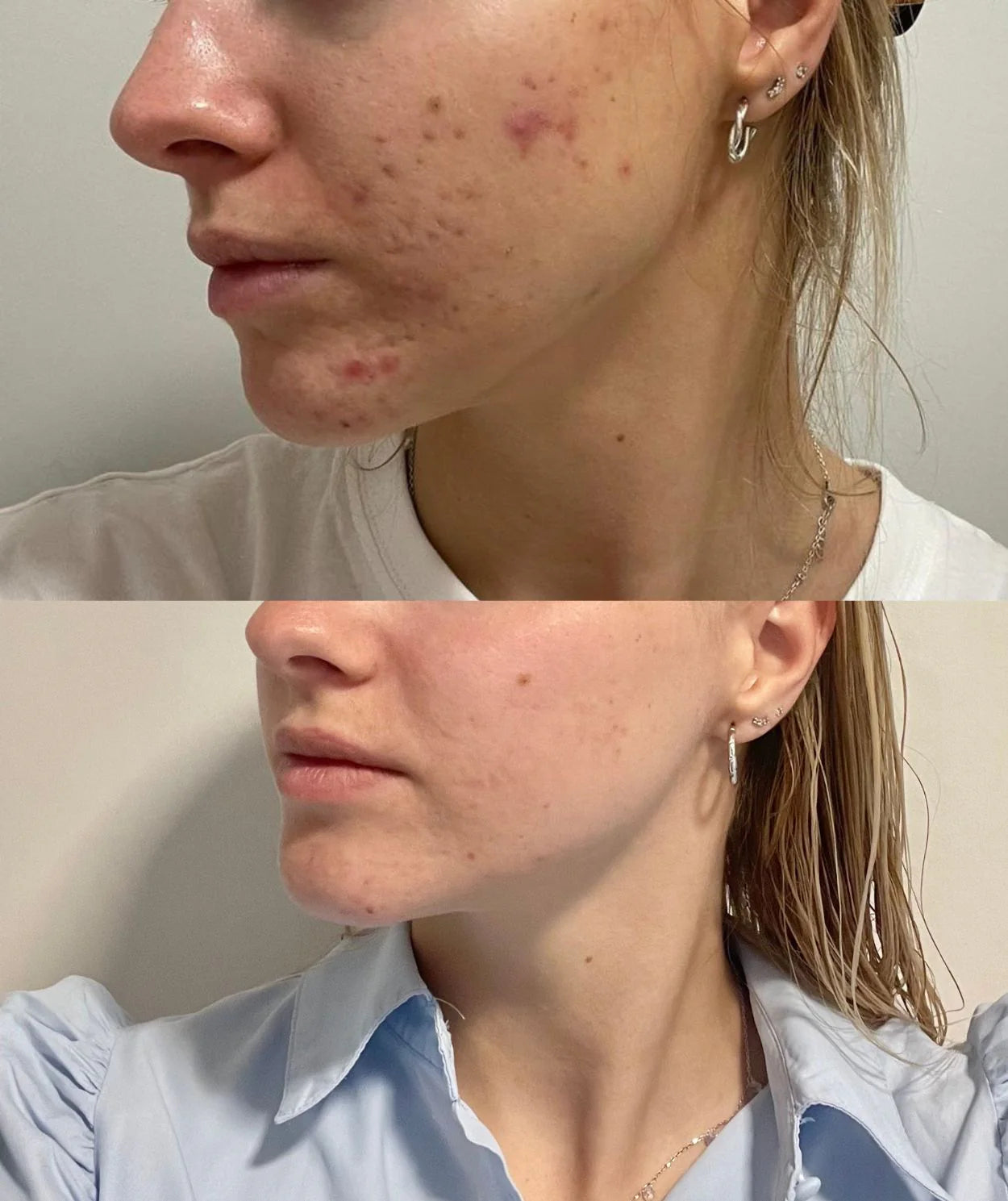 Ray. Pimple paste voor acne gevoelige huid