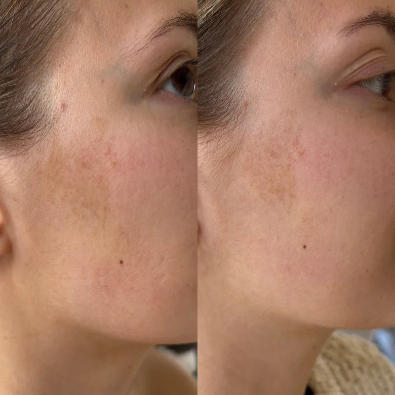 Ray.  Serum anti-pigment vlekken